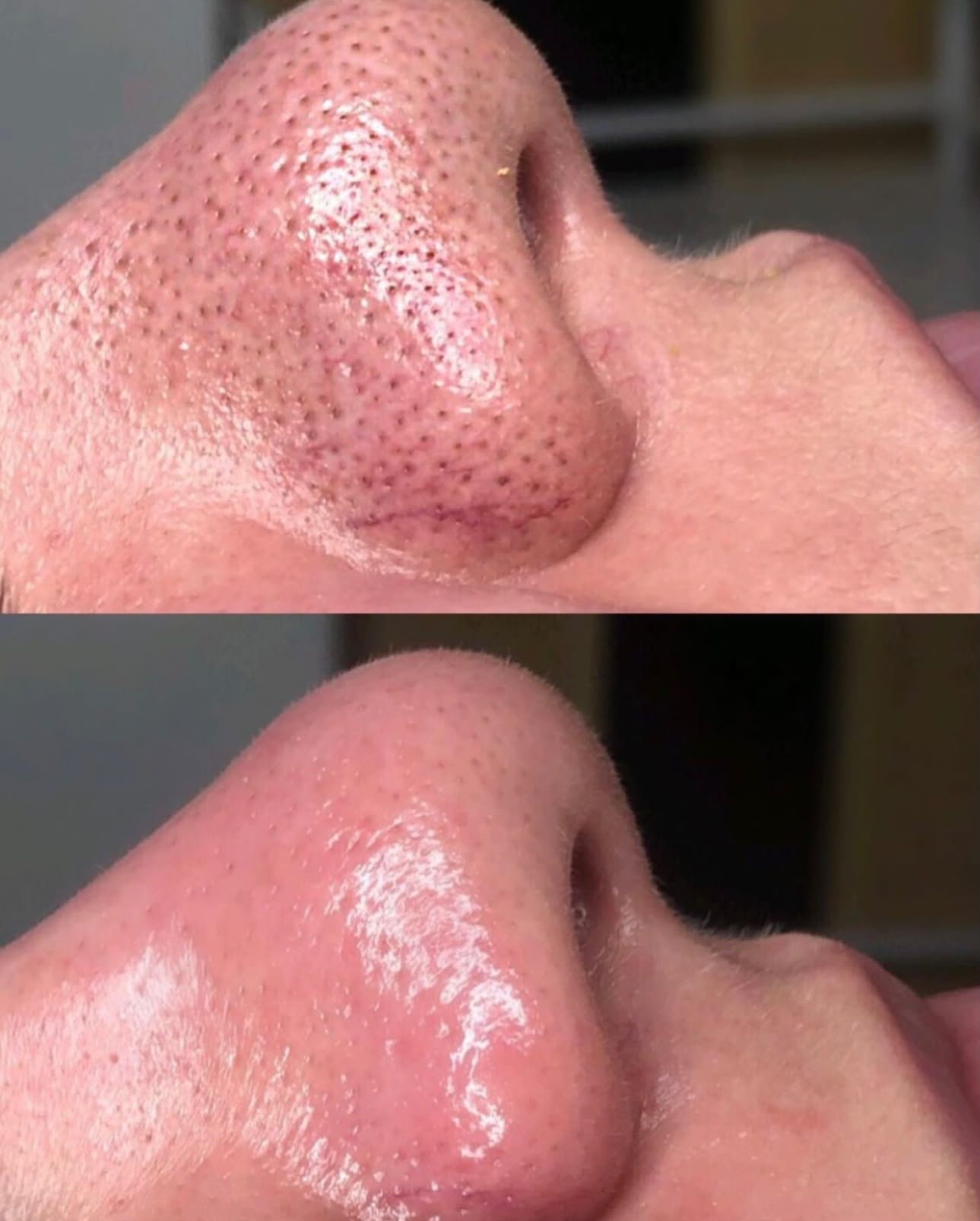 Skin Clarifying Treatment